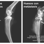 Boletin25_CICESE-3_huesos-metastasis